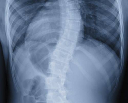 escoliosis-columnavertebral escoliosis-columnavertebral
