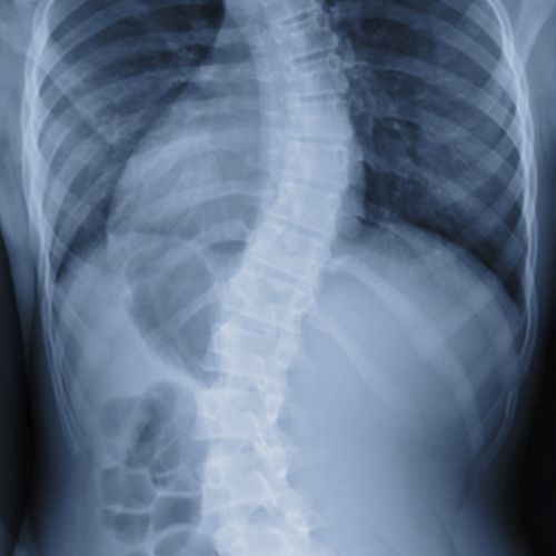 la escoliosis puede causar dolor muscular