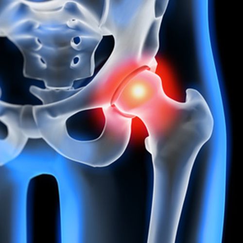 fisioterapia-protesis-cadera fisioterapia-protesis-cadera