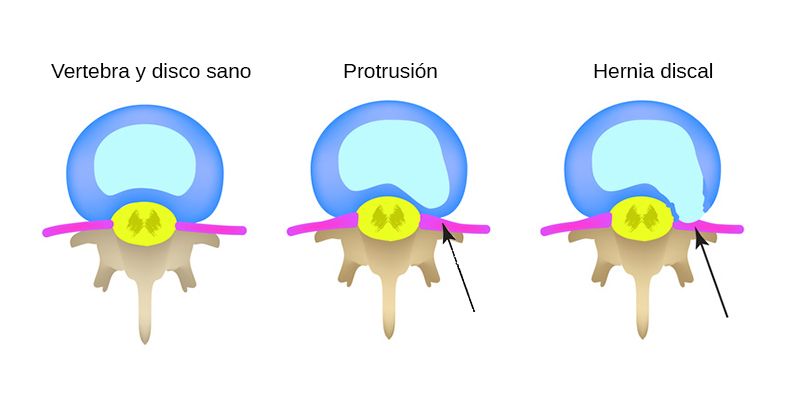 protrusion-discal-fisioterapia protrusion-discal-fisioterapia-columna-vertebral