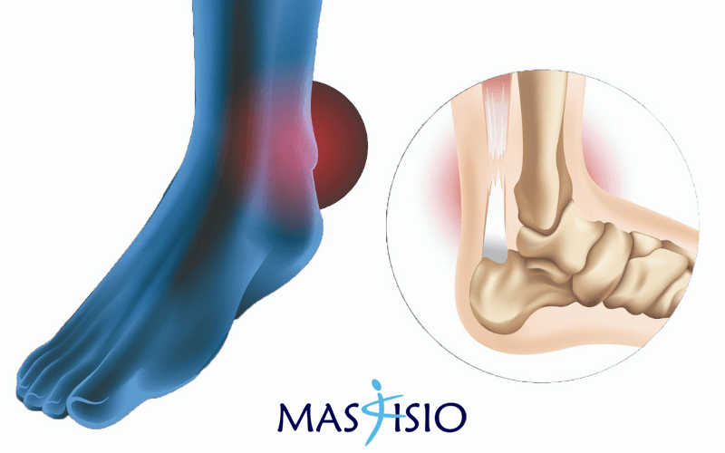 tendinitis-aquiles-roto tendinitis-aquiles-roto