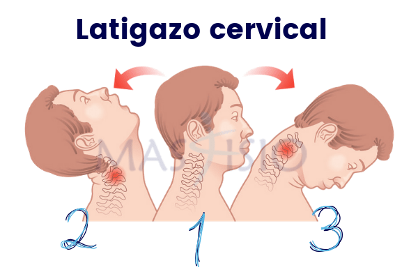 Latigazo cervical Latigazo cervical