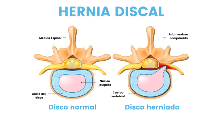 Hernia Discal - Fisioterapia Hernia Discal - Fisioterapia